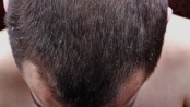 Vypadávání vlasů a ekzém