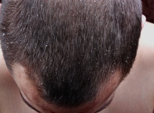 Vypadávání vlasů a ekzém